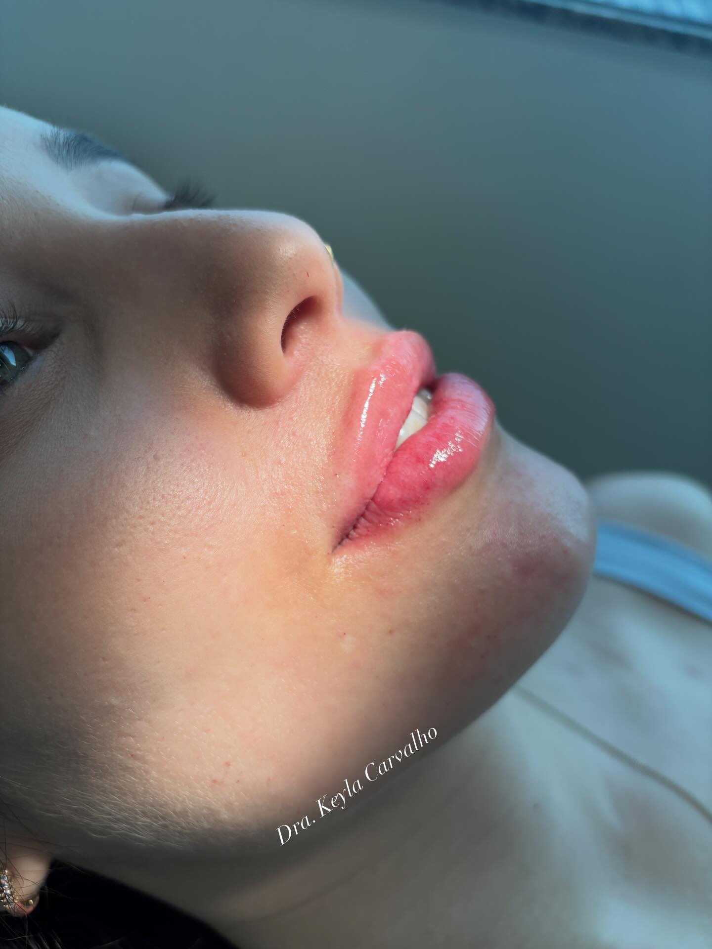 Harmonização Facial